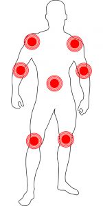 יאירה יסמין - דלקות בגידים